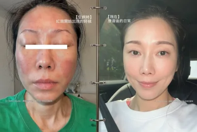 KIMIKO消失2週驚曝「鬼門關走一遭」!全身紅腫險昏厥