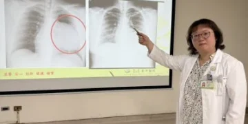 社會新鮮人求職健檢驚見15公分巨大腫瘤　胸腔鏡手術發現竟是畸胎瘤