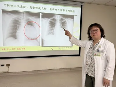 社會新鮮人求職健檢驚見15公分巨大腫瘤 胸腔鏡手術發現竟是畸胎瘤