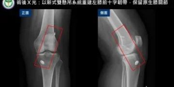 55歲婦膝蓋反覆軟腳竟是韌帶斷裂!台中醫院新式手術助保住原生膝關節