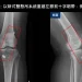 55歲婦膝蓋反覆軟腳竟是韌帶斷裂!台中醫院新式手術助保住原生膝關節