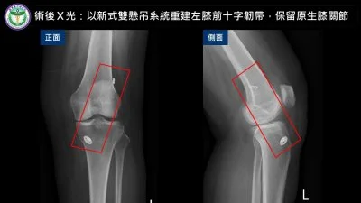 55歲婦膝蓋反覆軟腳竟是韌帶斷裂!台中醫院新式手術助保住原生膝關節