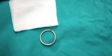 越南24歲男GG套3cm金屬環求壯陽卡死　拖10天才就醫「潰瘍流膿」險切除睪丸