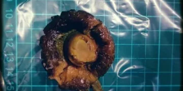 六旬男突發腹痛竟是腸阻塞！醫師開刀取出「整朵香菇」揭原因